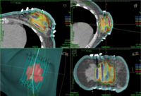 Zum Artikel "Teilbrustbestrahlung mit Multikatheter-Brachytherapie bringt beste Ergebnisse"