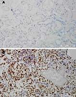 Zum Artikel "Nierenkrebs: Forscher enthüllen die Bedeutung des Erbguts"