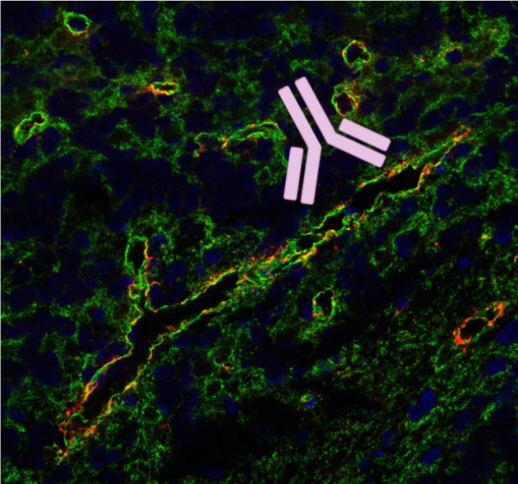 Seltene neurologische Autoimmunerkrankung: MLC1-Antikörper als möglicher Auslöser identifiziert
